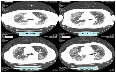 Dr.Zhong xiaoling Case report (Corona virus and Hyperbaric Therapy)