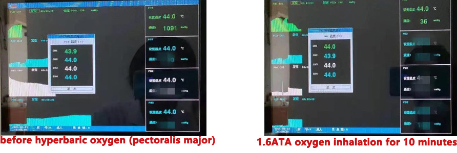 Transcutaneous pressure of Oximetry (tcpO2）-2