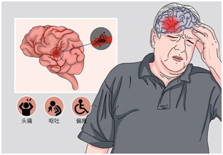 The role of hyperbaric oxygen in the treatment of cerebral hemorrhage