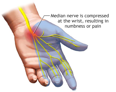 Application of hyperbaric oxygen in carpal tunnel syndrome