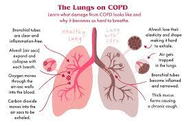 Oxygen chamber manufacturer: Treatment of COPD with HBOT in 2021