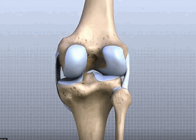 Application of Hyperbaric Oxygen in Rheumatoid Arthritis (RA)